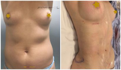 Lipoescultura - Dr. Rodolfo González Reynoso