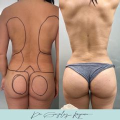 Lipoescultura - Dr. Rodolfo González Reynoso