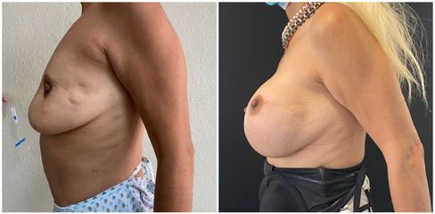 Mastopexia - Dr. Rodolfo González Reynoso