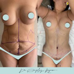 Abdominoplastia - Dr. Rodolfo González Reynoso
