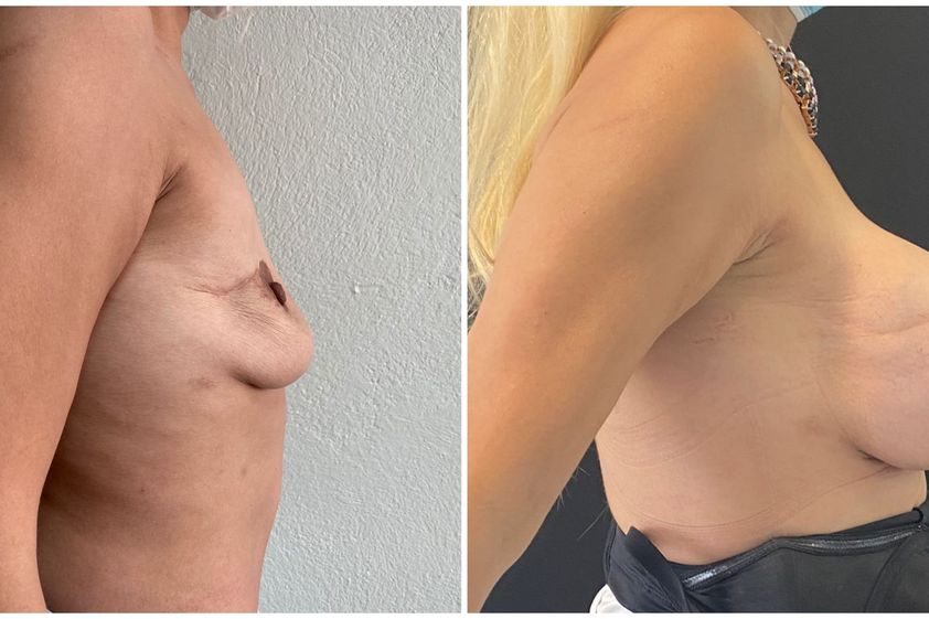 Mastopexia antes y después - 831159
