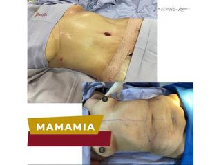 Abdominoplastia - Dr. Rodolfo González Reynoso