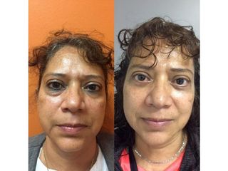 Antes y después de Rejuvenecimiento facial con toxina botulínica