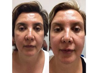 Antes y después de Rejuvenecimiento facial con toxina botulínica