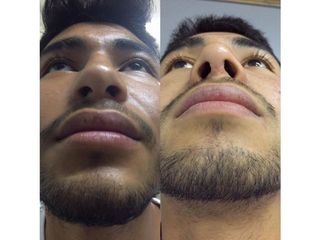 Antes y después de Rinoplastia