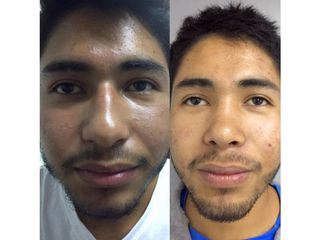 Antes y después de Rinoplastia