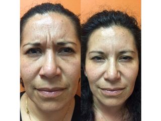 Antes y después de Rejuvenecimiento facial con toxina botulínica