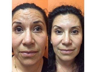 Antes y después de Rejuvenecimiento facial con toxina botulínica