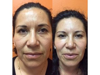 Antes y después de Rejuvenecimiento facial con toxina botulínica