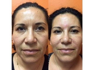 Antes y después de Rejuvenecimiento facial con toxina botulínica