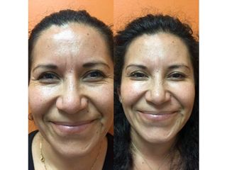 Antes y después de Rejuvenecimiento facial con toxina botulínica