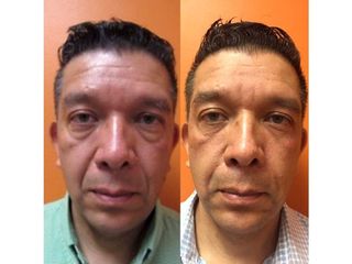 Antes y después de Rejuvenecimiento facial con toxina botulínica