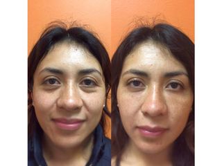 Antes y después de Rejuvenecimiento facial