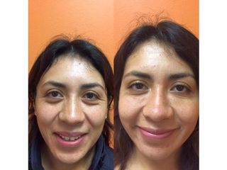 Antes y después de Rejuvenecimiento facial con toxina botulínica