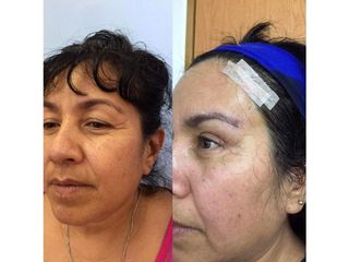 Antes y después de Rejuvenecimiento facial