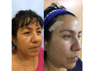 Antes y después de Rejuvenecimiento facial