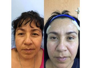 Antes y después de Rejuvenecimiento facial