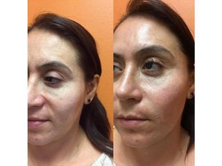 Antes y después de Rejuvenecimiento facial con ácido hialurónico