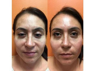 Antes y después de Rejuvenecimiento facial con ácido hialurónico