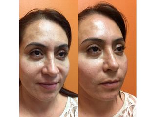 Antes y después de Rejuvenecimiento facial con ácido hialurónico