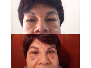 Antes y después de Rejuvenecimiento facial