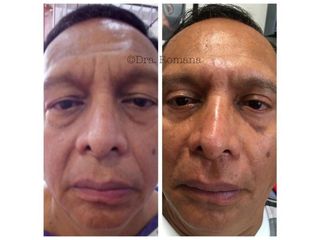 Antes y después de Rejuvenecimiento facial