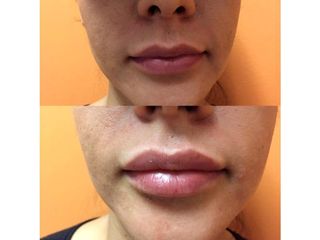 Antes y después de Aumento de labios