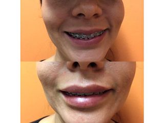 Antes y después de Aumento de labios