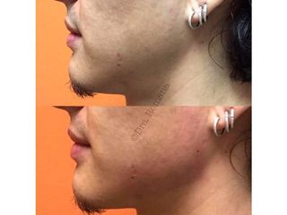 Antes y después de Aumento de labios