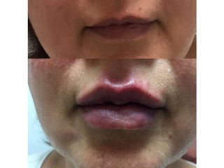 Antes y después de Aumento de labios