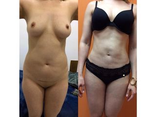 Antes y después de Lipoescultura