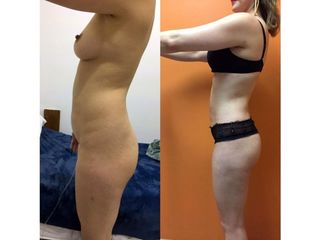 Antes y después de Lipoescultura
