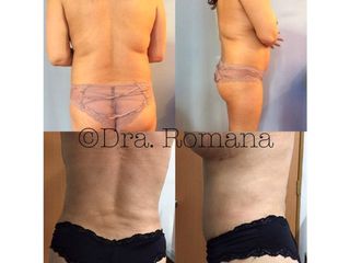 Antes y después de Lipoescultura