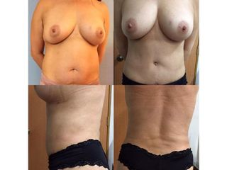 Antes y después de Lipoescultura