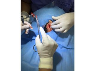 Otoplastia