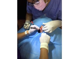 Otoplastia