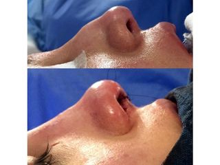 Antes y después de Rinoplastia