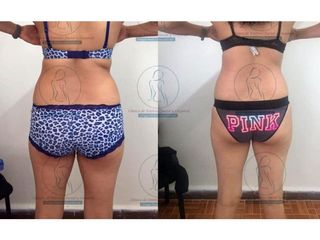 Antes y después de Liposucción