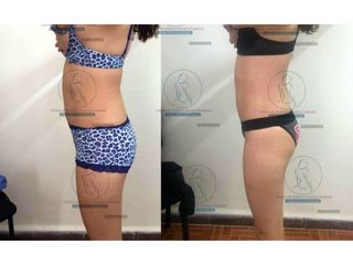 Antes y después de Liposucción