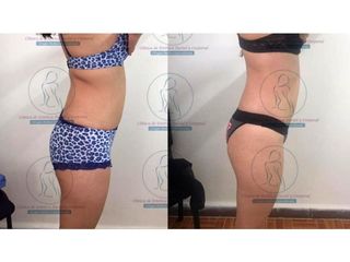 Antes y después de Liposucción