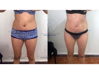Antes y después de Liposucción
