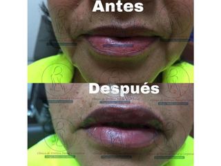 Antes y después de Aumento de labios