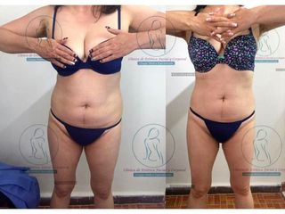 Antes y después de Liposucción