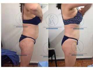 Antes y después de Liposucción