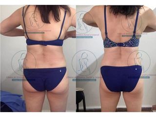 Antes y después de Liposucción