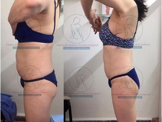 Antes y después de Liposucción