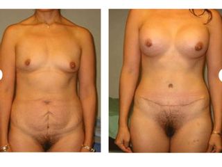 Antes y después de Abdominoplastia