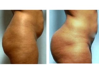 Antes y después de Gluteoplastia