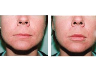 Antes y después de aumento de labios