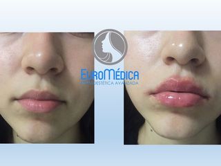 Antes y después de Aumento de labios con Ácido hialurónico